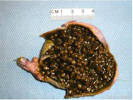 胆囊里装满了结石会怎么样_资料解释落实