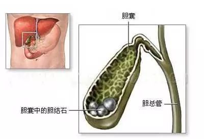 胆囊里的一颗结石，疾病解析与应对之道_解释定义