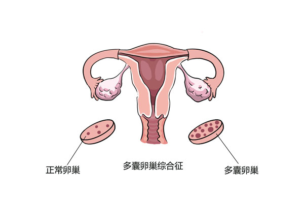 多囊不仅仅是一种妇科病